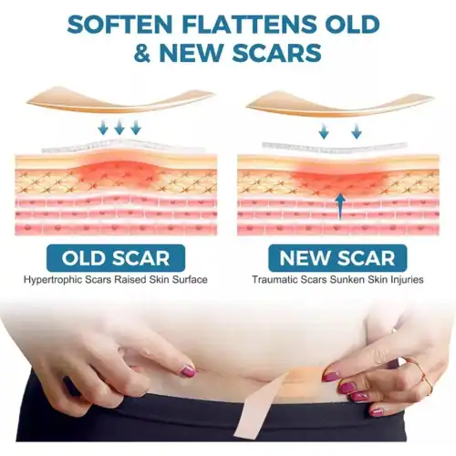 Tape Gel Silicona Suave Cicatrices Recovery 4cm X 1,5mt3